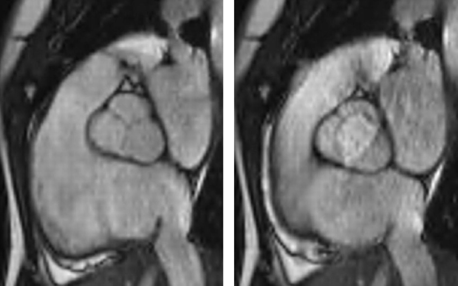 Bicuspidia Aortica Sintomi E Cure Per La Valvola Bicuspide