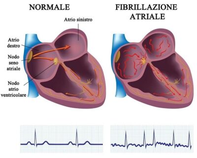 Cardioversione Elettrica Una Scossa Contro La Fibrillazione Atriale