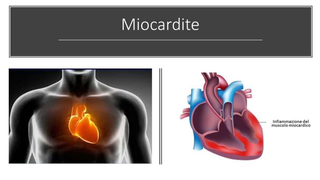 Cos’è La Miocardite E Come Si Cura