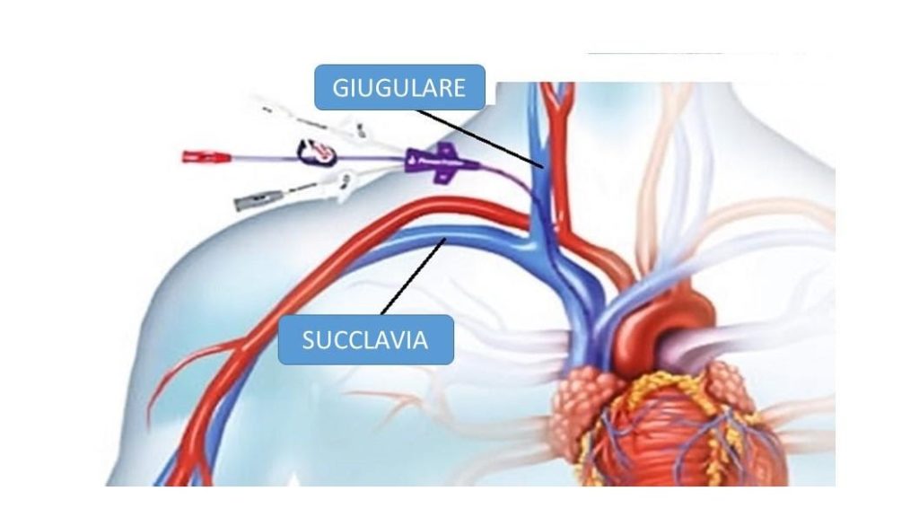 I Cateteri Venosi: Scopri Come Vengono Classificati