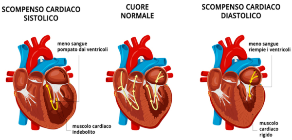 Scompenso Cardiaco: Sintomi, Cause E Diagnosi