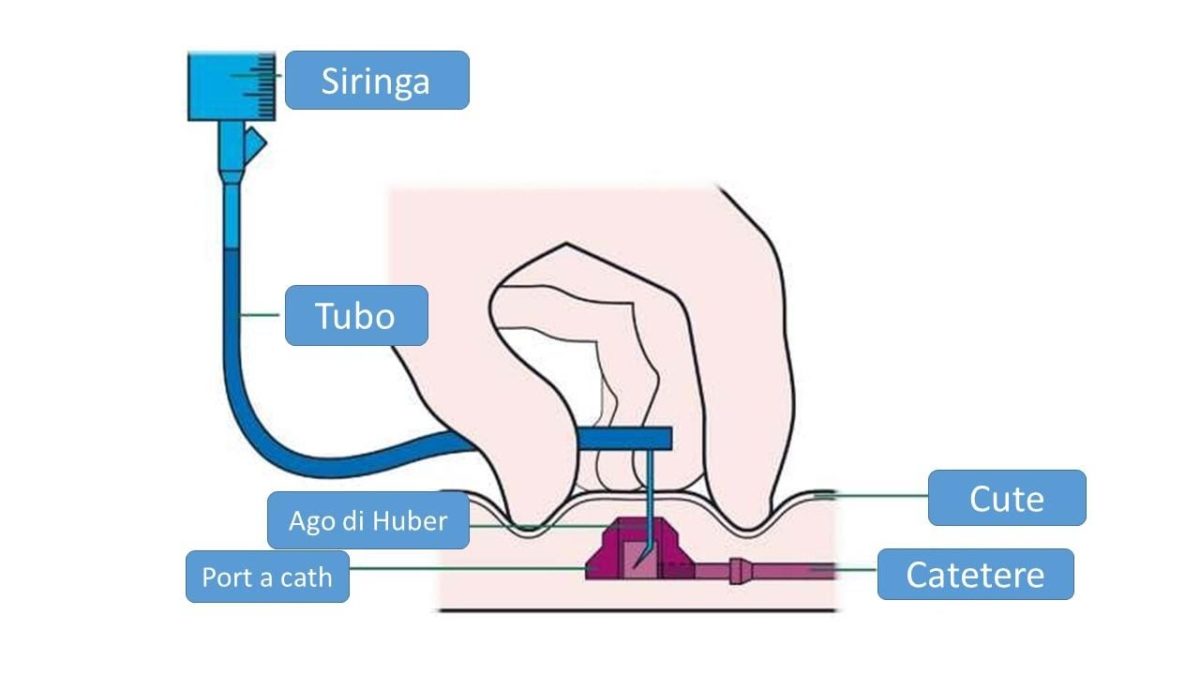I Cateteri Venosi: Scopri Come Vengono Classificati
