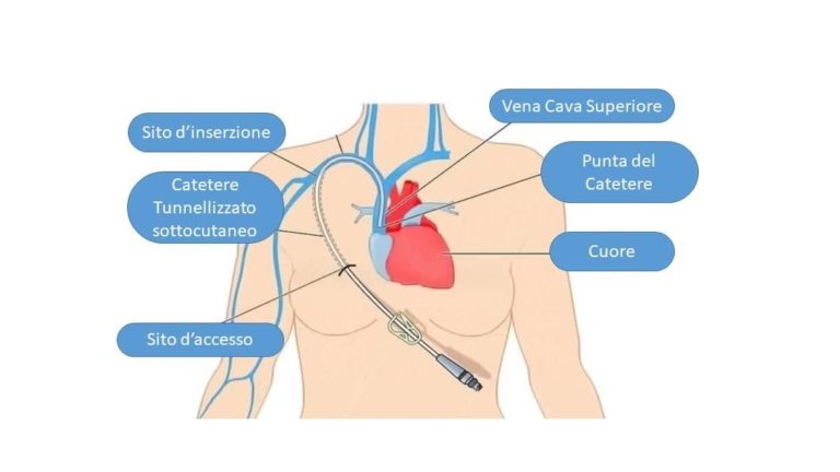 I Cateteri Venosi Scopri Come Vengono Classificati